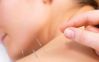 bienfait de l'acupuncture