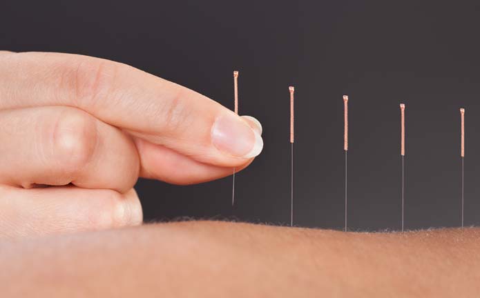 pourquoi l'acupuncture